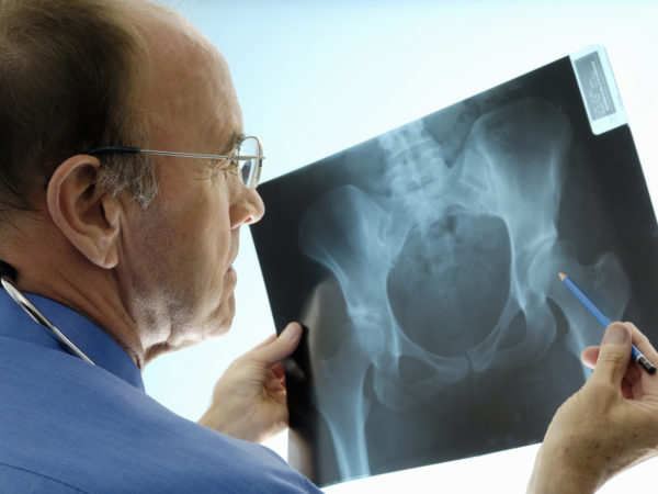 An experienced Caucasian orthopaedic surgeon (doctor) examining a pelvic x-ray displaying signs of osteoporosis - hip degeneration. Actual x-ray of a 42 year-old woman with a degenerative hip. The Orthopaedic surgeon is using a pencil to point at the hip where the problem is. This patient is a candidate (real) for hip replacement. The dominant colour is blue.