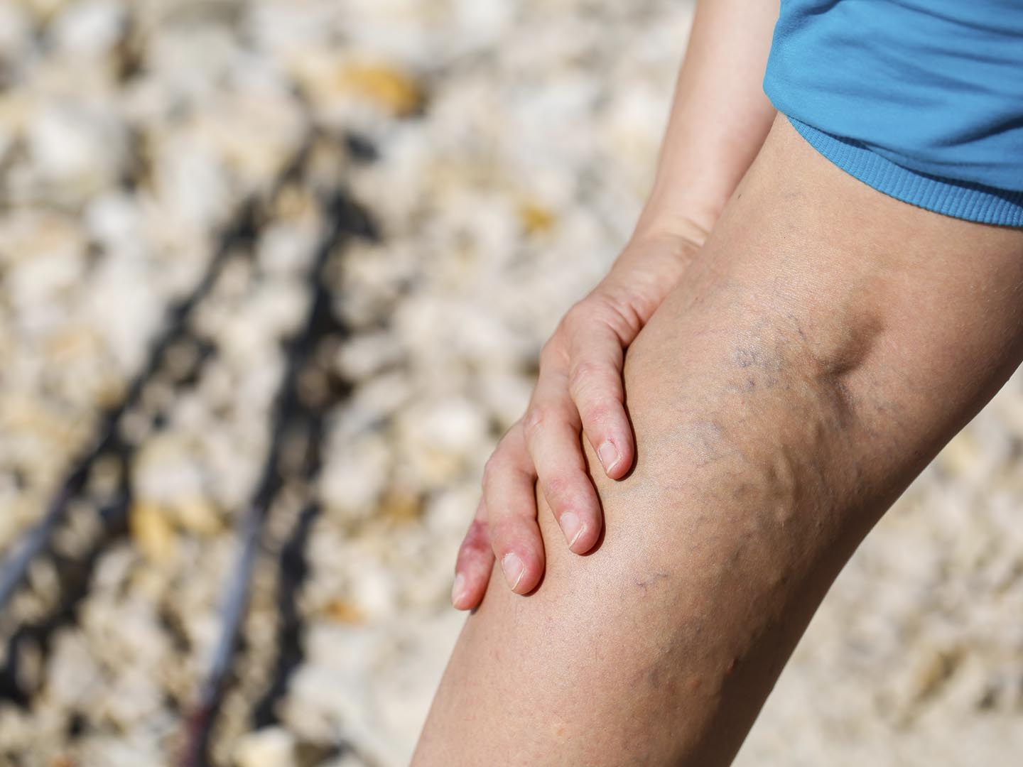 varicose vein support